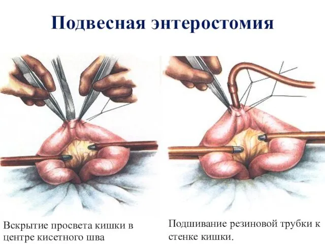 Подвесная энтеростомия Вскрытие просвета кишки в центре кисетного шва Подшивание резиновой трубки к стенке кишки.