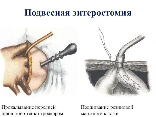 Подвесная энтеростомия Прокалывание передней брюшной стенки троакаром Подшивание резиновой манжетки к коже