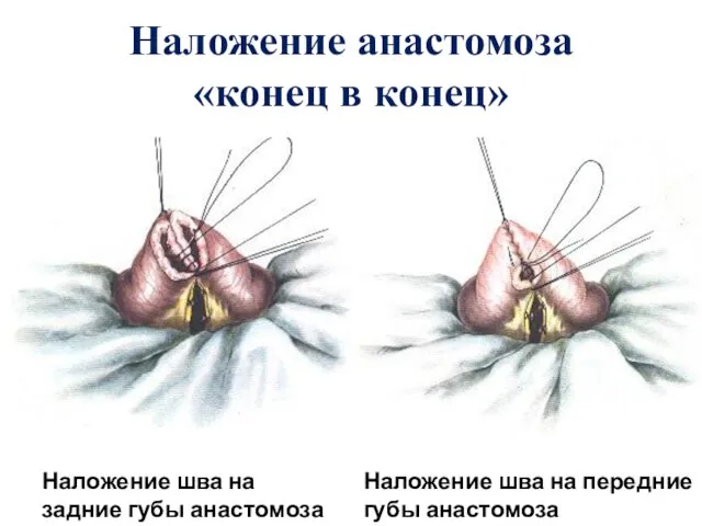 Наложение анастомоза «конец в конец» Наложение шва на задние губы анастомоза Наложение шва