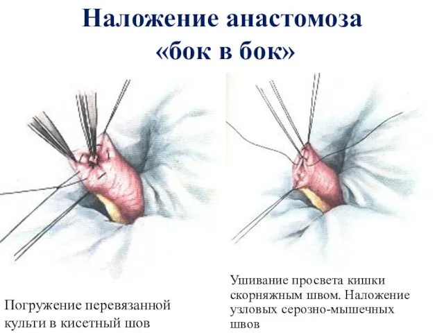 Наложение анастомоза «бок в бок» Погружение перевязанной культи в кисетный шов Ушивание просвета