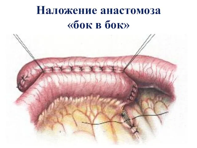 Наложение анастомоза «бок в бок»