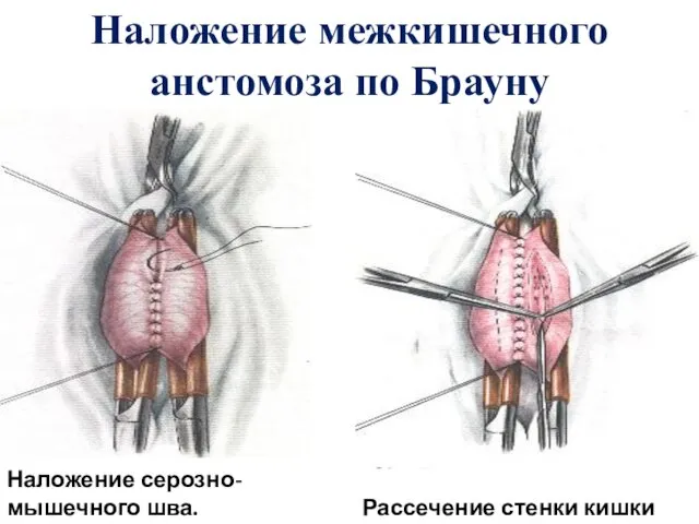 Наложение межкишечного анстомоза по Брауну Наложение серозно-мышечного шва. Рассечение стенки кишки