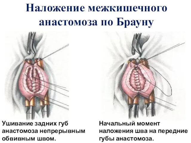 Наложение межкишечного анастомоза по Брауну Ушивание задних губ анастомоза непрерывным