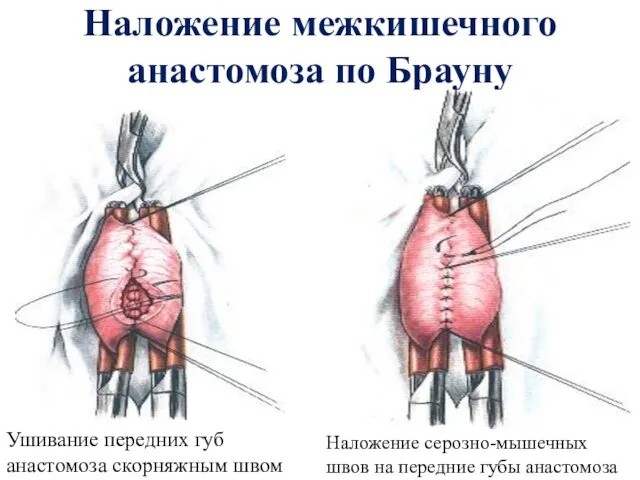 Наложение межкишечного анастомоза по Брауну Ушивание передних губ анастомоза скорняжным швом Наложение серозно-мышечных