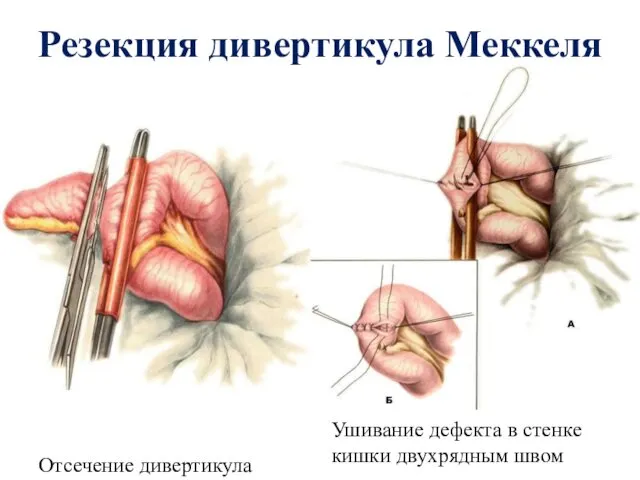 Резекция дивертикула Меккеля Отсечение дивертикула Ушивание дефекта в стенке кишки двухрядным швом