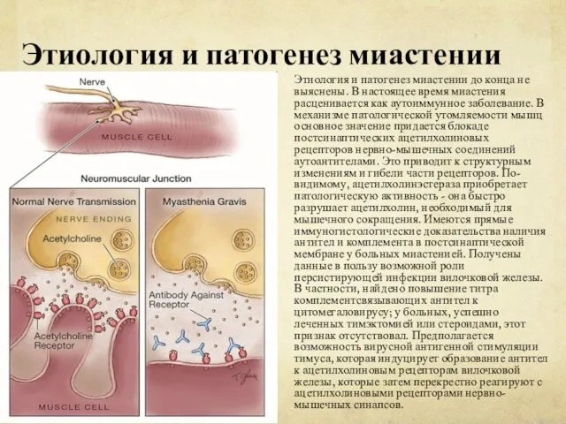 Этиология и патогенез миастении Этиология и патогенез миастении до конца