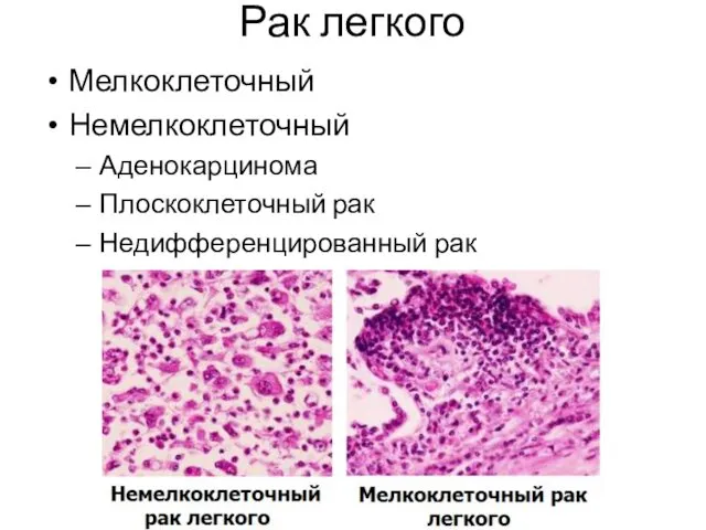 Рак легкого Мелкоклеточный Немелкоклеточный Аденокарцинома Плоскоклеточный рак Недифференцированный рак