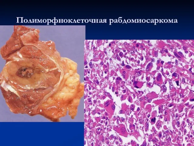 Полиморфноклеточная рабдомиосаркома