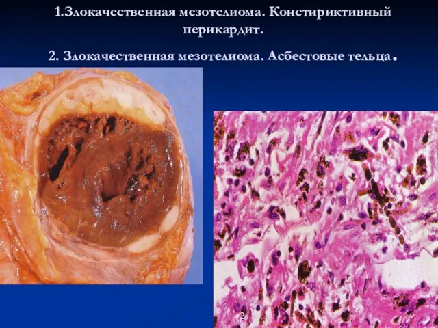 1.Злокачественная мезотелиома. Констириктивный перикардит. 2. Злокачественная мезотелиома. Асбестовые тельца. 1 2