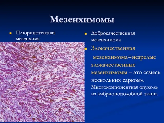 Мезенхимомы Плюрипотентная мезенхима Доброкачественная мезенхимома Злокачественная мезенхимома=незрелые злокачественные мезенхимомы –