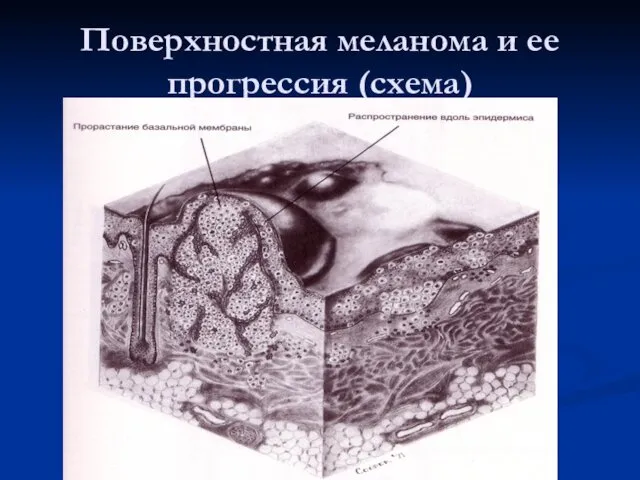 Поверхностная меланома и ее прогрессия (схема)