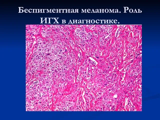 Беспигментная меланома. Роль ИГХ в диагностике.