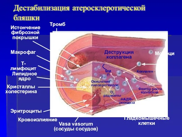 Дестабилизация атеросклеротической бляшки