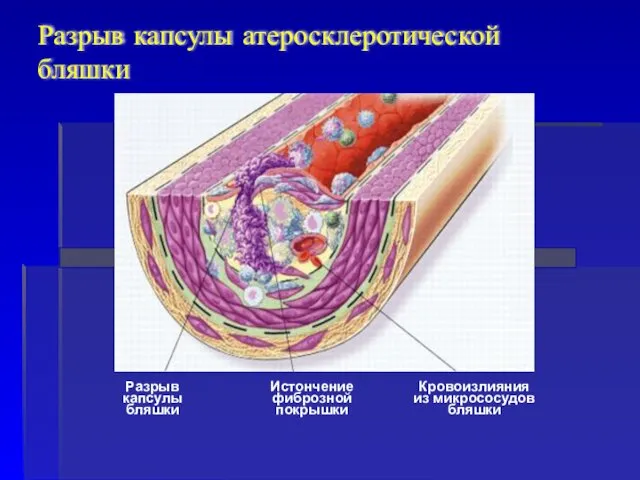 Истончение фиброзной покрышки Кровоизлияния из микрососудов бляшки Разрыв капсулы бляшки Разрыв капсулы атеросклеротической бляшки