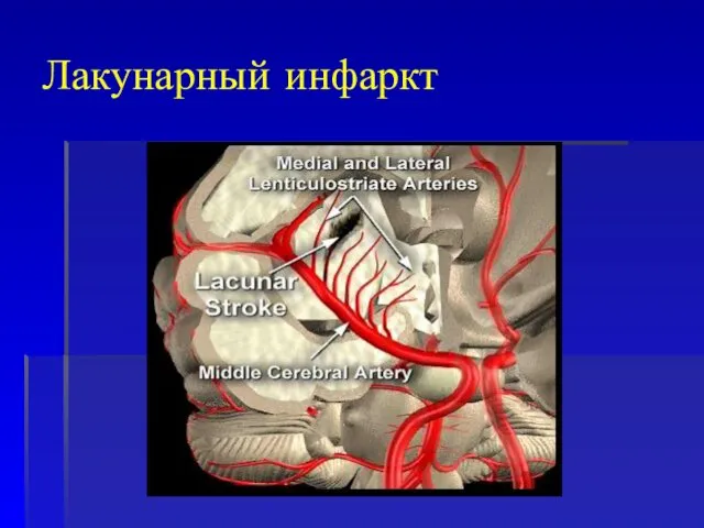 Лакунарный инфаркт