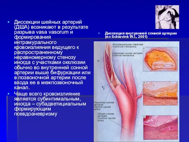 Диссекции шейных артерий (ДША) возникают в результате разрыва vasa vasorum