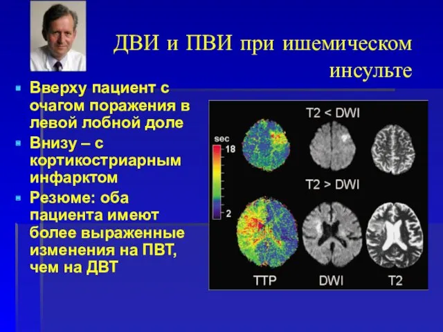 ДВИ и ПВИ при ишемическом инсульте Вверху пациент с очагом