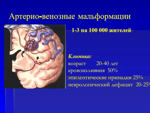 1-3 на 100 000 жителей Клиника: возраст 20-40 лет кровоизлияния