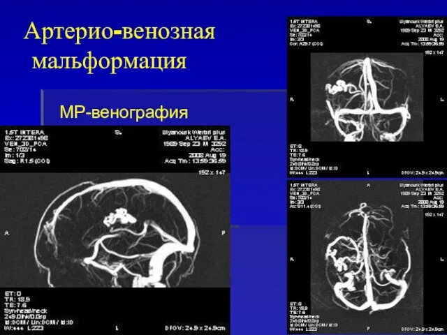 МР-венография Артерио-венозная мальформация