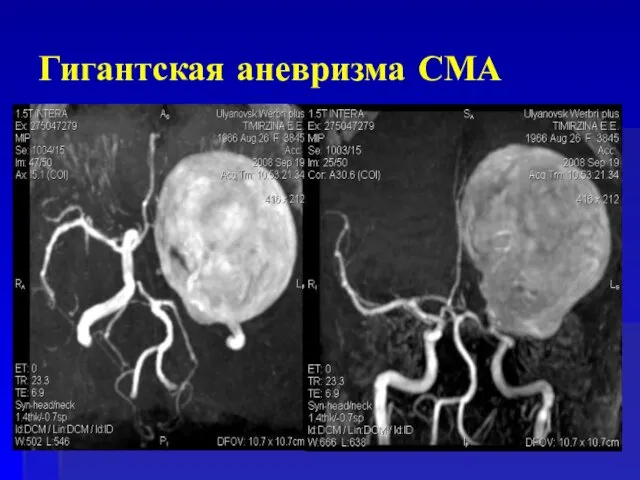 Гигантская аневризма СМА