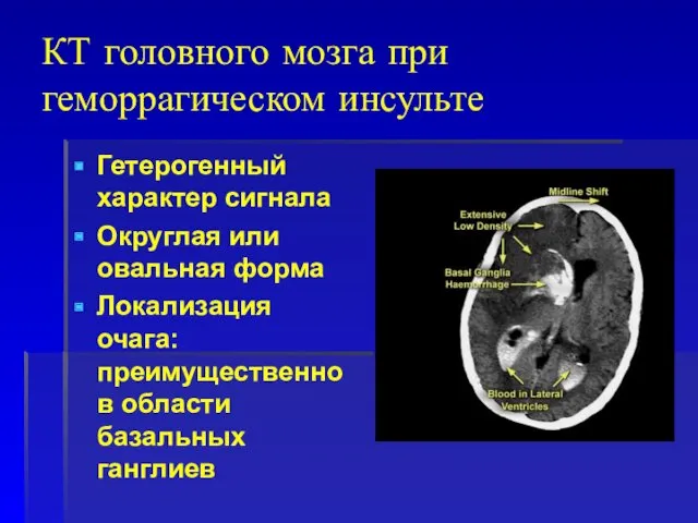 КТ головного мозга при геморрагическом инсульте Гетерогенный характер сигнала Округлая