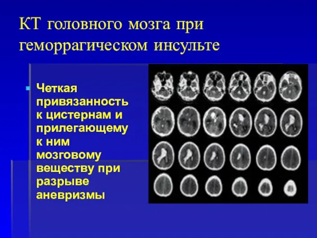 КТ головного мозга при геморрагическом инсульте Четкая привязанность к цистернам