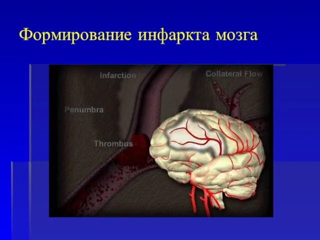 Формирование инфаркта мозга