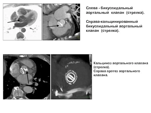 Слева - бикуспидальный аортальный клапан (стрелка). Справа-кальцинированный бикуспидальный аортальный клапан