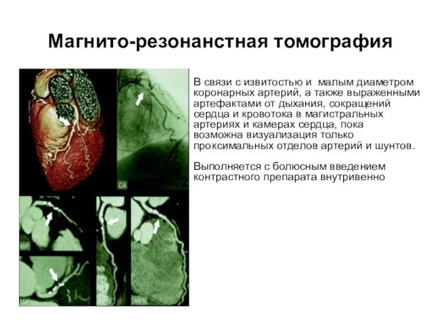 Магнито-резонанстная томография В связи с извитостью и малым диаметром коронарных