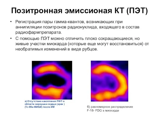 Позитронная эмиссионая КТ (ПЭТ) Регистрация пары гамма-квантов, возникающих при аннигиляции