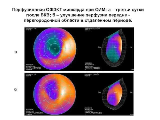 Перфузионная ОФЭКТ миокарда при ОИМ: а – третьи сутки после