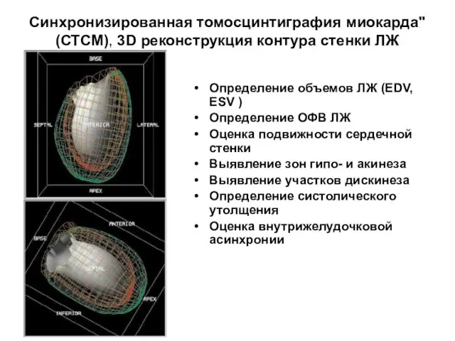 Синхронизированная томосцинтиграфия миокарда" (СТСМ), 3D реконструкция контура стенки ЛЖ Определение