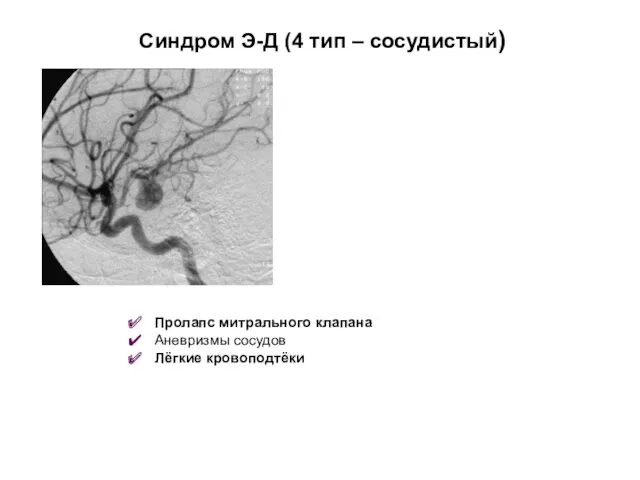 Синдром Э-Д (4 тип – сосудистый) Пролапс митрального клапана Аневризмы сосудов Лёгкие кровоподтёки