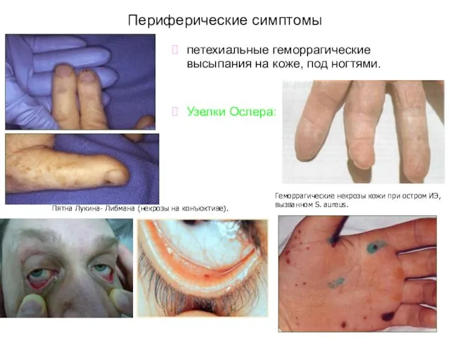 Периферические симптомы петехиальные геморрагические высыпания на коже, под ногтями. Узелки