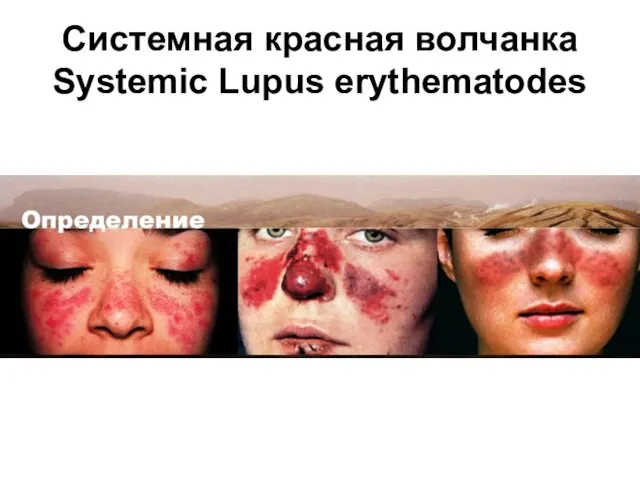 Системная красная волчанка Systemic Lupus erythematodes