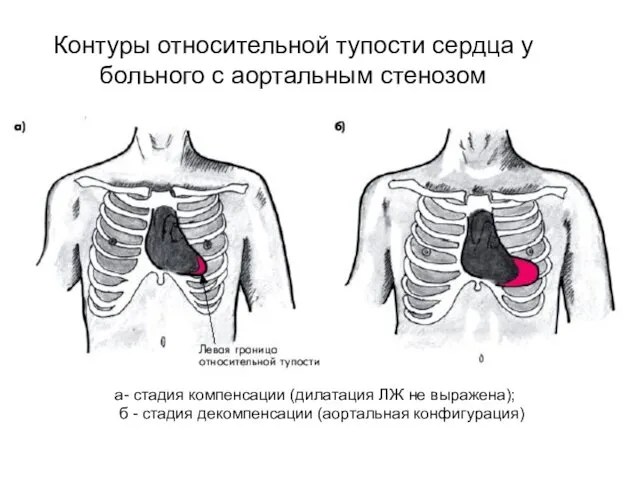 Контуры относительной тупости сердца у больного с аортальным стенозом а-