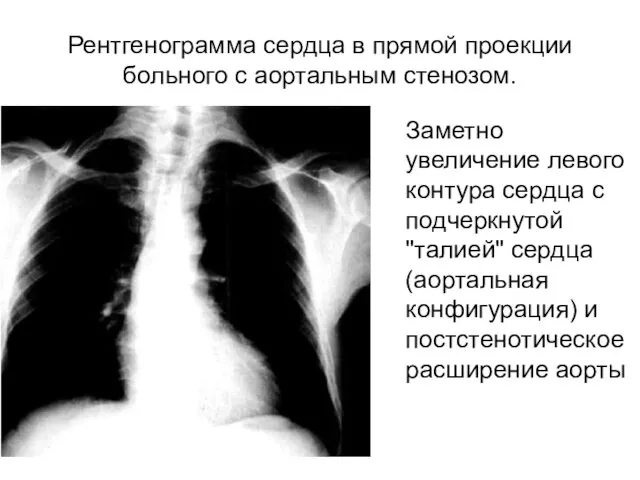 Рентгенограмма сердца в прямой проекции больного с аортальным стенозом. Заметно