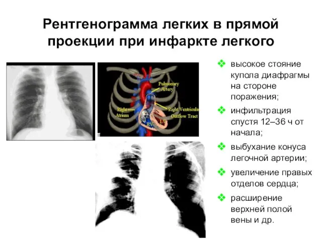 Рентгенограмма легких в прямой проекции при инфаркте легкого высокое стояние