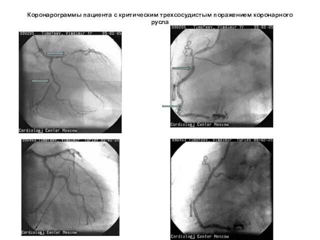 Коронарограммы пациента с критическим трехсосудистым поражением коронарного русла