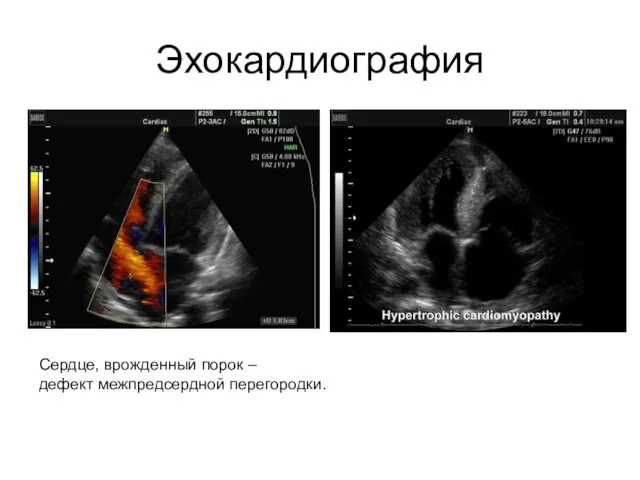 Эхокардиография Сердце, врожденный порок – дефект межпредсердной перегородки.