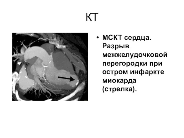 КТ МСКТ сердца. Разрыв межжелудочковой перегородки при остром инфаркте миокарда (стрелка).