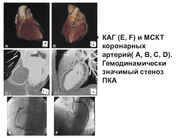 КАГ (E, F) и МСКТ коронарных артерий( A, B, C, D). Гемодинамически значимый стеноз ПКА