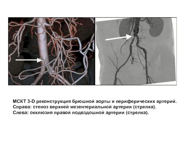 МСКТ 3-D реконструкция брюшной аорты и периферических артерий. Справа: стеноз