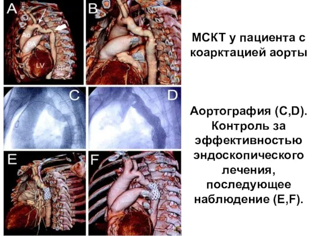 МСКТ у пациента с коарктацией аорты Аортография (С,D). Контроль за эффективностью эндоскопического лечения, последующее наблюдение (E,F).