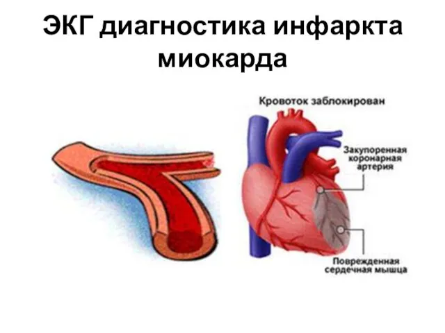 ЭКГ диагностика инфаркта миокарда