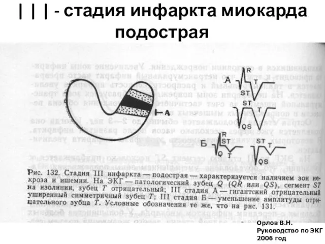 Орлов В.Н. Руководство по ЭКГ 2006 год | | | - стадия инфаркта миокарда подострая