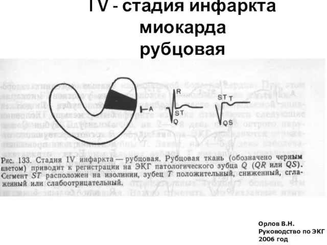 Орлов В.Н. Руководство по ЭКГ 2006 год l V - стадия инфаркта миокарда рубцовая