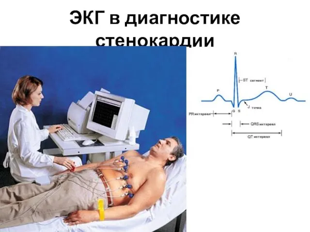 ЭКГ в диагностике стенокардии