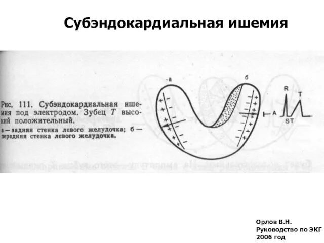 Орлов В.Н. Руководство по ЭКГ 2006 год Субэндокардиальная ишемия