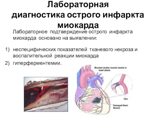 Лабораторная диагностика острого инфаркта миокарда Лабораторное подтверждение острого инфаркта миокарда